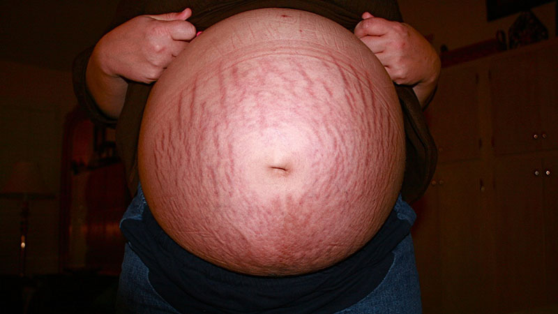 why-do-you-get-stretch-marks-my-postpartum-wellness